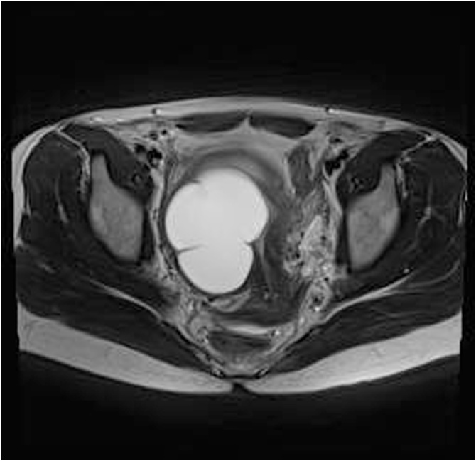 Myometrial cysts: A case series - PMC