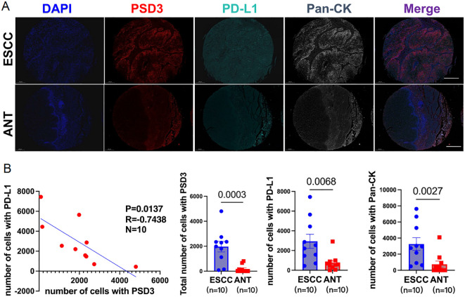 Panel A displays immunofluorescence images of ESCC and ANT tissues stained with DAPI, PSD3, PD-L1, and Pan-CK, with a merged image showing co-localization. Panel B consists of a scatter plot and bar graphs. The scatter plot shows a negative correlation between the number of cells with PSD3 and PD-L1, with P=0.0137 and R=-0.7438. The bar graphs reveal differences in the number of cells with PSD3, PD-L1, and Pan-CK between ESCC and ANT, with P-values of 0.0003, 0.0068, and 0.0027, respectively.