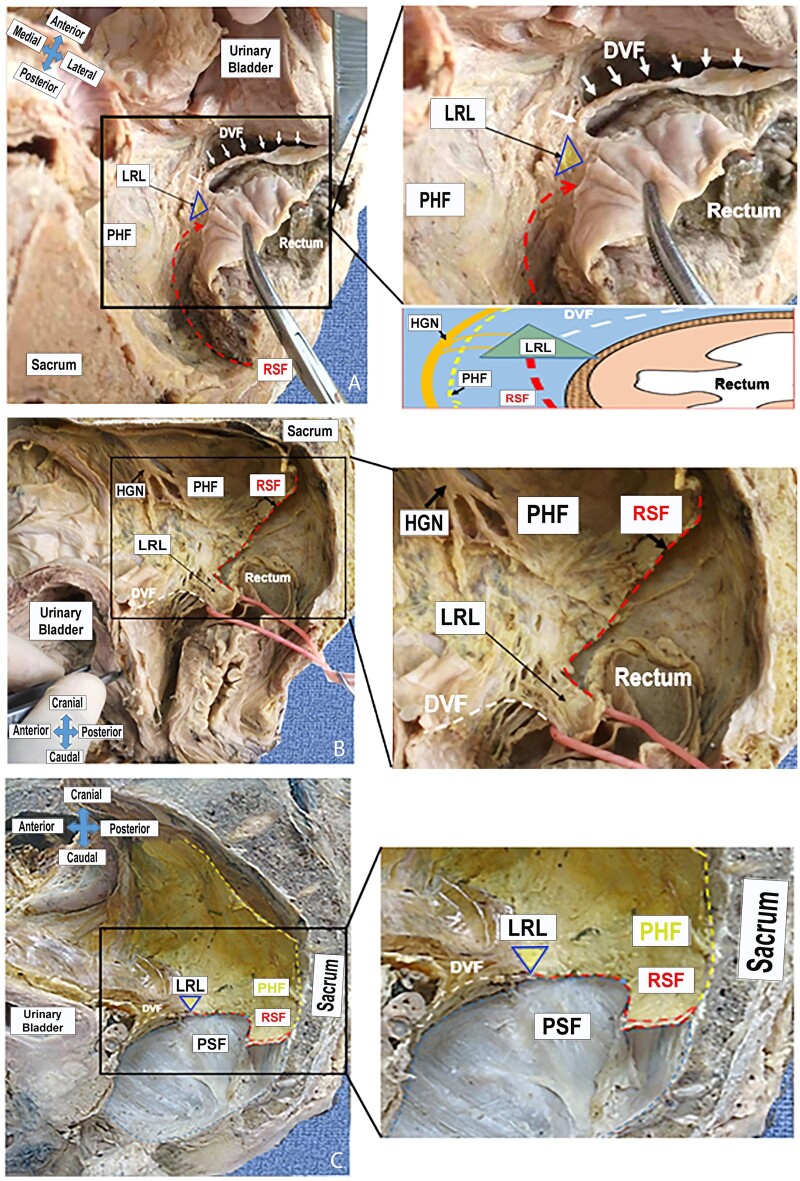 Anatomy of the perirectal fascia at the level of rectosacral fascia ...