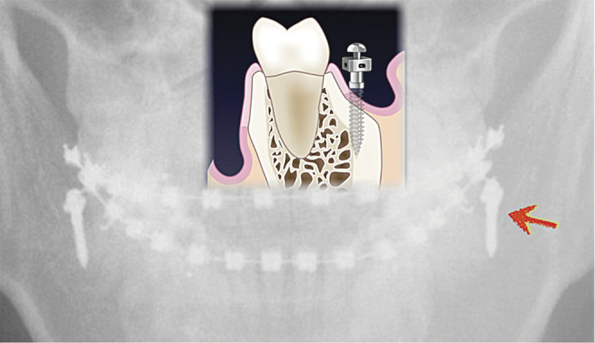 Figure 6. A drawing superimposed on a radiograph shows that a properly positioned screw is buccal to the molars roots.