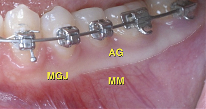 Figure 4. The mucogingival junction (MGJ) separates the attached gingiva (AG) from the movable mucosa (MM).