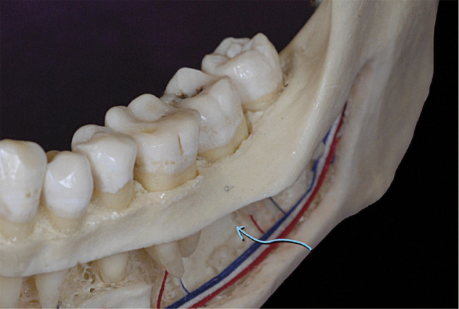 Figure 3. A lateral cutaway view of a human mandible shows the area of available bone (arrow) for placing a buccal shelf bone screw.