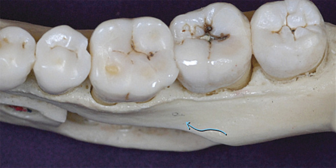 Figure 2. An occlusal view of a human mandible shows the available bone in the buccal shelf area (arrow).