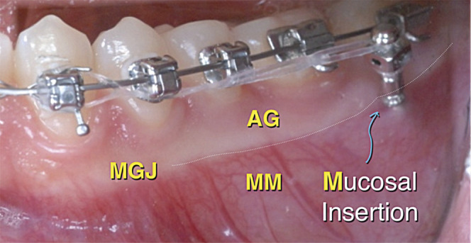 Figure 5. Screw insertion point may penetrate AG or MM but the head of the screw must be at least 5 mm above the level of the soft tissue.