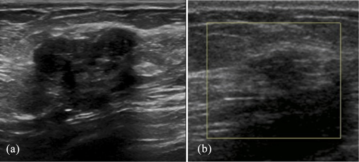 Underestimation of malignancy in biopsy-proven cases of stromal ...