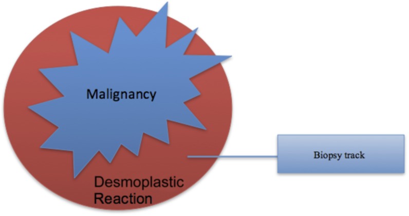 Underestimation of malignancy in biopsy-proven cases of stromal ...