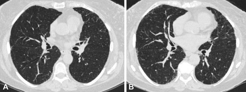 Axial chest CT scans (0.75-mm section thickness, reconstructed with b31f kernel; Siemens Medical Solutions) at (A) visit 1 and (B) visit 2 at the level of the takeoff of the right middle bronchus of a participant with 1.2 annual percentage quantitative interstitial abnormality progression. The female participant was 62 years old at visit 1 and 67 years old at visit 2 and a current smoker at both visits, with a 47.5 pack-year history at visit 2. This participant had four subsequent acute respiratory disease (ARD) events and three subsequent severe ARD events.