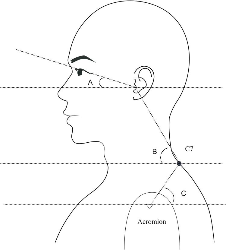 The Predictive Value and Influencing Factors of Craniocervical Flexion ...