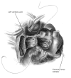Biatrial technique using left atrial anastomosis