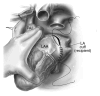Bicaval technique using left atrial anastomosis