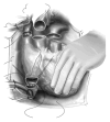 Inferior and superior vena cavae anastomosis for bicaval technique