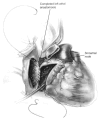 Biatrial technique using right atrial anastomosis