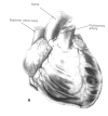 Shumway’s donor cardiectomy dividing the anterior vessels