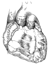 All the anastomoses completed for the biatrial technique