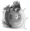 Recipient mediastinum after cardiectomy