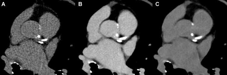 Representative CT images with coronary artery calcifications. Axial CT images in an 81-year-old female patient with severe aortic stenosis show (A) true noncontrast (at 70 keV without quantum iterative reconstruction [QIR]), (B) late enhancement (at 55 keV with QIR 4), and (C) virtual noncontrast (at 70 keV with QIR 4). Volume CT dose index of the true noncontrast and the late enhancement scans were 2.6 mGy and 6.3 mGy, respectively. The coronary artery calcium scores were 1336 on true noncontrast images and 1411 on virtual noncontrast images (70 keV with QIR 4). Note that small calcifications in the aortic root were removed on virtual noncontrast images, while coronary calcifications appear similar on true noncontrast and virtual noncontrast images.