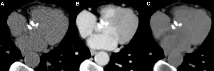 Representative CT images with aortic valve calcifications. Axial CT images in a 75-year-old female patient with severe aortic stenosis show (A) true noncontrast (at 70 keV without quantum iterative reconstruction [QIR]), (B) late enhancement (at 55 keV with QIR 3), and (C) virtual noncontrast (at 80 keV with QIR 3). Volume CT dose index of the true noncontrast and late enhancement scans were 1.9 mGy and 4.6 mGy, respectively. The aortic valve calcium scores were 2053 on true noncontrast images and 2051 on virtual noncontrast images (at 80 keV with QIR 4).