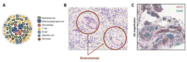 Efzofitimod: a novel anti-inflammatory agent for sarcoidosis - PMC