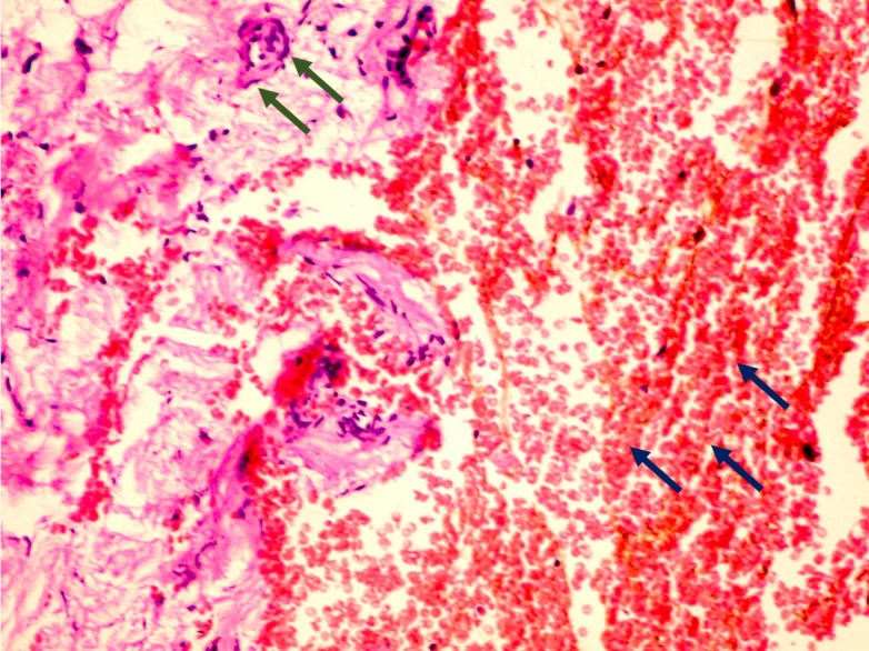 Figure 4. Haemorrhage within periosteum (Blue arrows and Blood vessel (Green arrows).