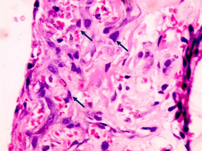 Figure 2. Triangular-shaped Osteoprogenitor cells (Blue arrows).