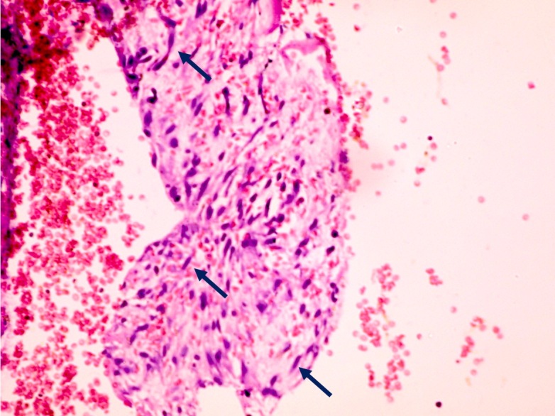 Figure 3. Fibrous layer with long elongated fibroblasts (Blue arrows).