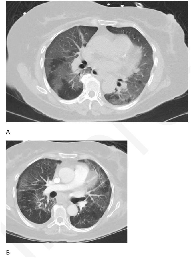 (A) Axial chest CT on lung windows of patient #3 at initial presentation demonstrates widespread diffuse ground glass opacities affecting all five lobes. (B) Follow-up image 27 days later demonstrates decreasing ground glass opacities, with areas of subpleural clearance.