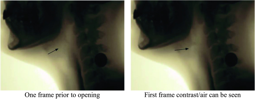 2 x ray images of the lower jaw and the neck region of a person. The first image was obtained one frame prior to opening the laryngeal vestibule. In the second image, first frame contrast or air can be seen.