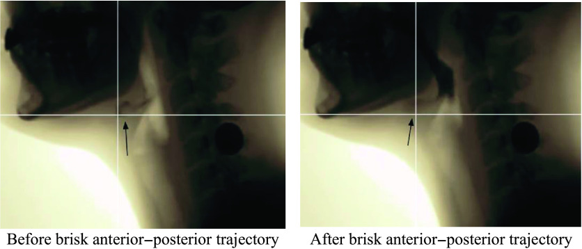 2 x ray images of the jaw and neck region. The title of the first image is Before brisk anterior, posterior trajectory. An up arrow points to a region below the rear jaw. The title of the second image is After brisk anterior, posterior trajectory. A diagonal arrow points to a region below the rear jaw.