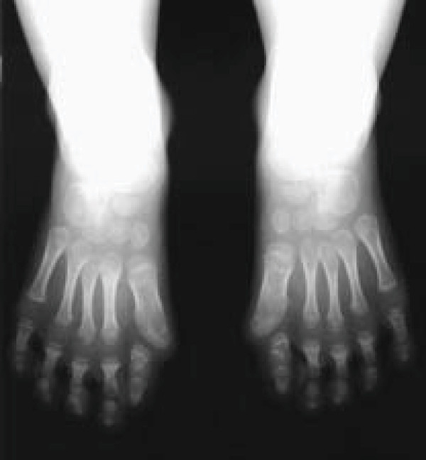 Fibrodysplasia Ossificans Progressiva: Clinical and Genetic Aspects - PMC