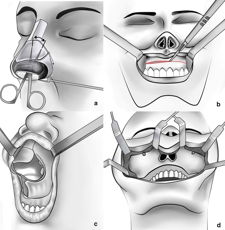 Utility of the Midface Degloving Approach for Extended Exposure in ...