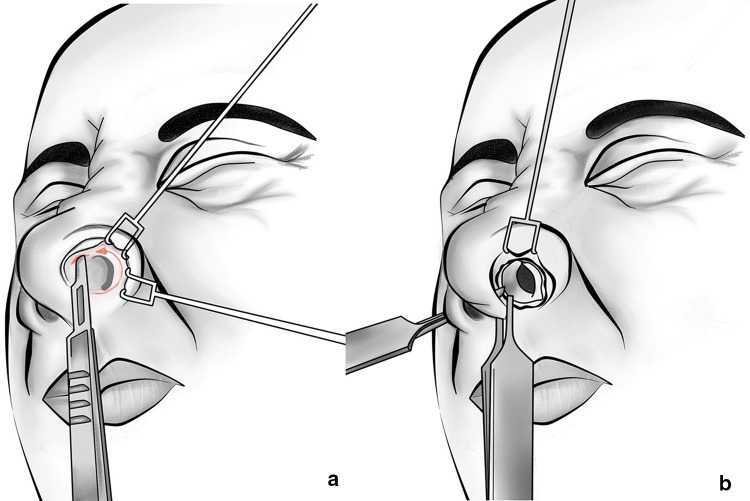 Utility of the Midface Degloving Approach for Extended Exposure in ...