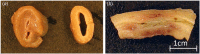 Esophageal resections post-IRE-treatment. Photographs of unfixed wIRE treated swine esophagus in (a) axial, treated section are on the left and an untreated control esophagus is on the right, and (b) transverse cross section immediately following euthanasia. IRE treatment manifests as submucosal edema and transmural discoloration of the esophageal lumen.