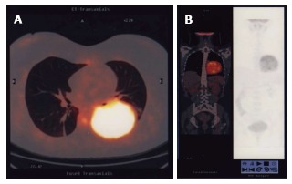 Adult pulmonary blastoma: Report of an unusual malignant lung tumor - PMC