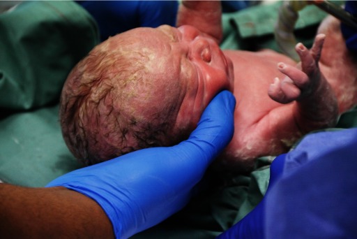 Photograph of an infant being born