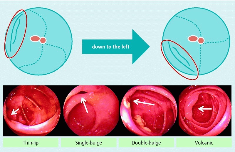 Patient-posture and Ileal-intubation during colonoscopy (PIC): a ...