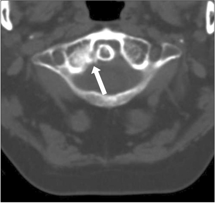 Unrecognized C1 Lateral Mass Fracture Without Instability; The Origin ...