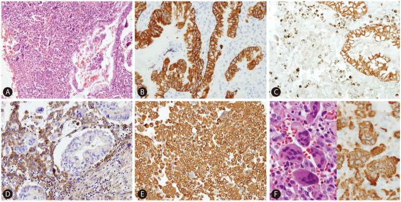 Sarcomatoid cholangiocarcinoma with osteoclast-like giant cells ... image.