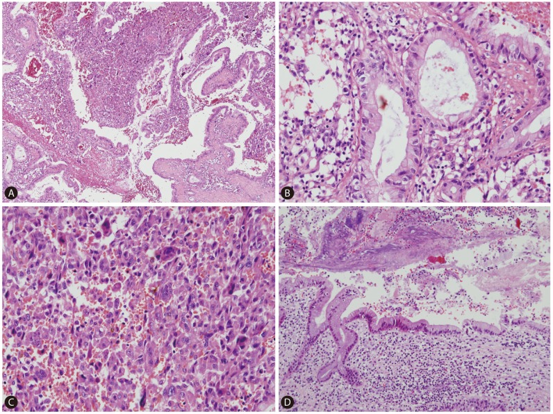 Sarcomatoid cholangiocarcinoma with osteoclast-like giant cells ...