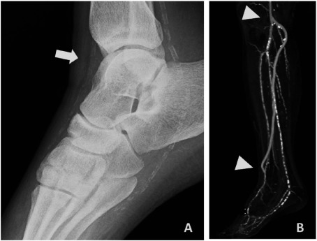 Fig. 2 Foot plain X-ray film (panel A) and CT angiogram after bypass surgery (panel B). X-ray film shows heavy calcification in his infrapopliteal arterial tree, but there are some less calcium segments especially around ankle joint (arrow in panel A). If the calcium-free space can be found like this case, the anastomosis will not be difficult. The arrowheads indicate each anastomotic site (panel B).