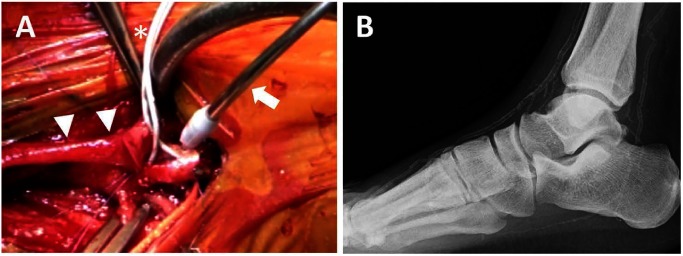 Fig. 3 Operative view of a distal anastomosis to dorsalis pedis artery of dialysis-dependent patient (panel A). Two balloon catheters (*) are using to block arterial flow. A CO2 blower (arrow) is also useful to blow away blood and create bloodless field. Arrow heads indicate vein graft. Panel B shows the plain X-ray of the foot underwent the bypass surgery introduced in panel A.