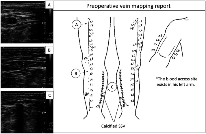 Fig. 1 Preoperative ultrasound examination in a CLI case with end-staged renal failure on hemodialysis for 13 years. Infrapopliteal segment of right GSV looks poor quality (panel B) and both SSV walls are calcified with acoustic shadow (panel C). Both limbs underwent popliteo-pedal bypasses using upper half of GSVs as non-reversed fashion. CLI: critical limb ischemia; GSV: great saphenous vein; SSV: small saphenous vein