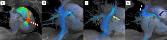 Four-dimensional flow visualization of Fontan circuit and caval flow distribution in a 27-year-old man with double-inlet left ventricle and Fontan palliation. In A, there is flow acceleration across the bulboventricular foramen. (B) Streamlines show distribution of Fontan, or inferior vena cava, flow and Glenn, or superior vena cava, flow to both lungs. (C) Fontan, or inferior vena cava, flow streams preferentially into the right lower lobe (orange dashed arrow) and left lung (green arrow), while in D Glenn, or superior vena cava, flow streams preferentially into the right upper lobe (white arrow) and left lower lobe (purple dashed arrow).