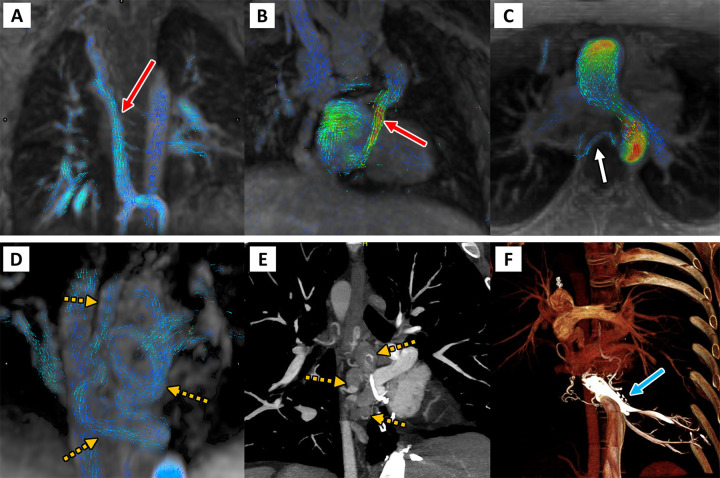 Four-dimensional (4D) flow visualization of venovenous and aortopulmonary collateral vessels to determine the cause of systemic-pulmonary venous shunting. First are two patients with large venovenous collateral vessels (red arrow), (A) a 5-year-old boy and (B) a 12-year-old boy, with drainage directly into the atrium bypassing the pulmonary arteries. (C) In a 13-year-old girl, a small aortopulmonary collateral artery is seen arising from the descending thoracic aorta (white arrow). Finally, on the bottom row, a 33-year-old man with large serpiginous venous collateral vessels (orange dashed arrows in D and E) is shown on (D) 4D flow and on (E, F) cardiac CT angiographic images, illustrating large venous varices and their direct supply from the hepatic venous confluence (blue arrow).