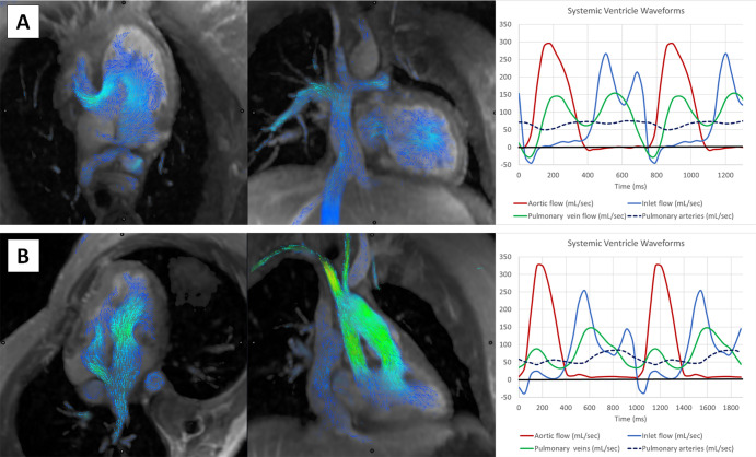 Visualization of the Fontan circuit and flow volume waveforms with four-dimensional flow MRI. (A) In the top row, images in an 18-year-old woman with tricuspid atresia and Fontan palliation. Mitral inflow volume curves show normal E/A ratio and equal pulmonary venous systolic and diastolic waves. (B) In the bottom row, images in a 29-year-old man with double-outlet right ventricle and Fontan palliation with depressed systolic function and moderate diastolic dysfunction. Mitral inflow volumes show normal E/A ratio but depressed pulmonary venous systolic wave and increased pulmonary venous diastolic wave.