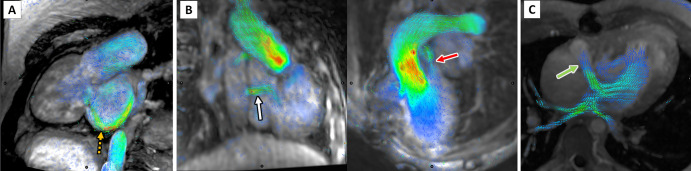 Four-dimensional flow visualization of atrioventricular valve insufficiency and additional shunts. (A) Image in a 24-year-old man with atrioventricular canal with severe inlet valve regurgitation during late systole, indicated by the orange dashed arrow. Note the absence of aortic flow as the ventricular pressure decompresses into the atrium. (B) Images in a 6-year-old girl with double-outlet right ventricle with Fontan fenestration (white arrow) and incomplete ligation of the pulmonary artery (red arrow). (C) Image in a 28-year-old man with right-to-left flow through a fenestration (green arrow) from an atrial Fontan.