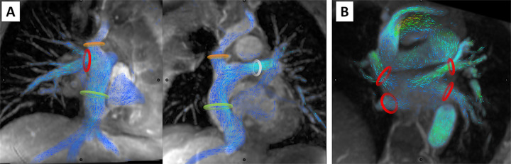 Measurement of systemic and pulmonary venous return in the Fontan circuit. In (A), the superior vena cava, or Glenn shunt (orange ring), the inferior vena cava, or Fontan conduit (green ring), right pulmonary artery (red ring), and left pulmonary artery (white ring) indicate the locations of flow volume measurement of passive systemic venous return. In (B), the red rings mark the locations of flow volume measurement of each of the pulmonary veins.