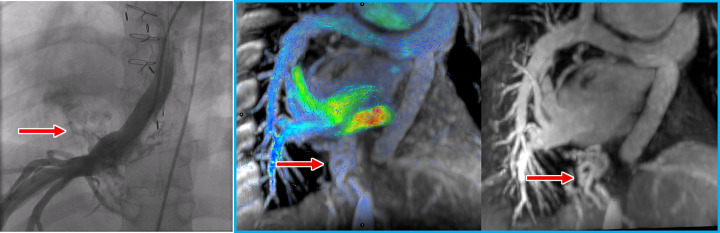 Venovenous collateral vessels (red arrows) at (from left to right) catheter angiography, four-dimensional (4D) flow, and contrast-enhanced MR angiography in a 27-year-old man with pulmonary atresia. These collateral vessels arise from the hepatic veins and directly drain into right pulmonary veins, bypassing the Fontan and pulmonary arteries to the lower-pressure pulmonary veins. Contrast-enhanced MR angiography can be performed in a single breath hold immediately preceding the free-breathing 4D flow scan in the same session as part of a comprehensive congenital heart MRI and MR angiography.