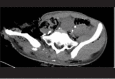 <b>Fig. 1b</b>: Plain radiograph showed wide diastasis of symphysis
pubis and separation of right sacroiliac joint.