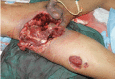<b>Fig. 1a</b>: Anterior view of traumatic right hemipelvectomy wound.