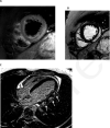 22-year-old male with COVID-19, shortness of breath, and chest pain. Cardiac MRI showed mildly reduced left ventricular systolic function with an ejection fraction of 47%. A, T2 short axis image through the apical segments demonstrates subepicardial edema (high signal, arrow) along the lateral wall. B, C, There is corresponding subepicardial lateral wall late gadolinium enhancement on short axis (B, arrow) and 4-chamber (C, arrows) images.